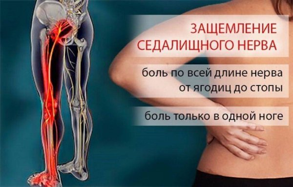 Защемление седалищного нерва упражнения
