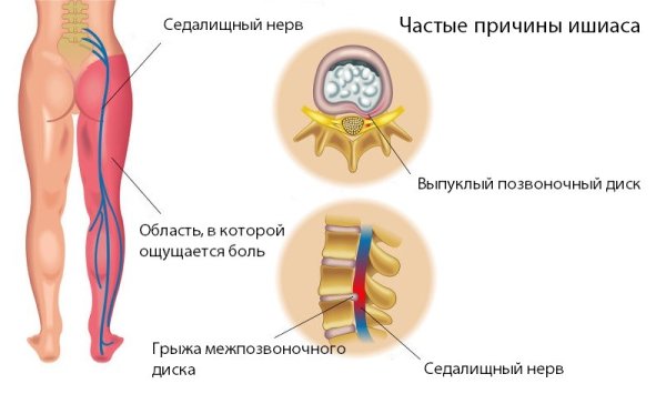 Ишиас воспаление седалищного