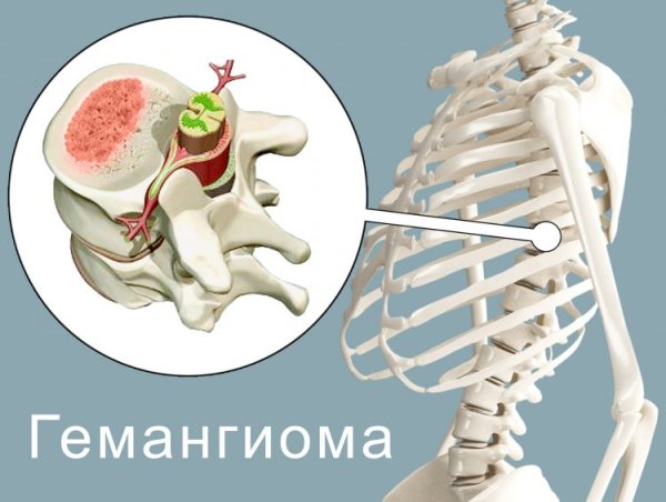 Гемангиома позвоночника l2