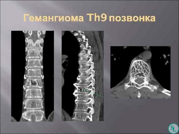 Гемангиома th9 позвонка что это такое