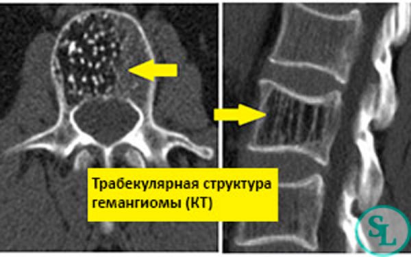 Гемангиома позвоночника кт
