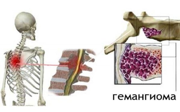 Гемангиома th2 позвонка шейного отдела