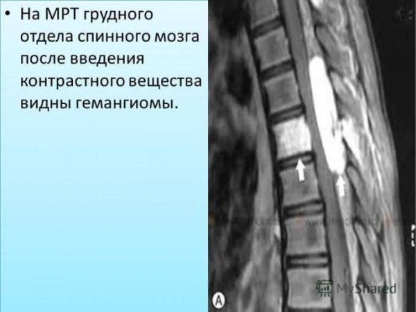 Гемангиома позвоночника l2