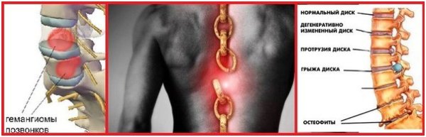 Гемангиома грудного отдела позвоночника th7