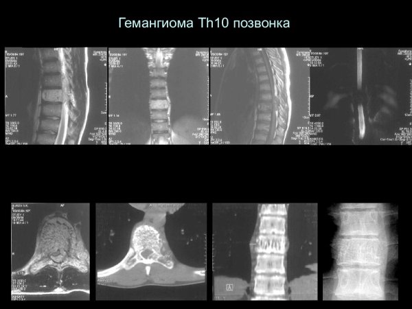 Гемангиома th10 позвонка