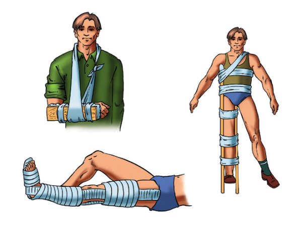 Иммобилизация верхней конечности при переломе и вывихе