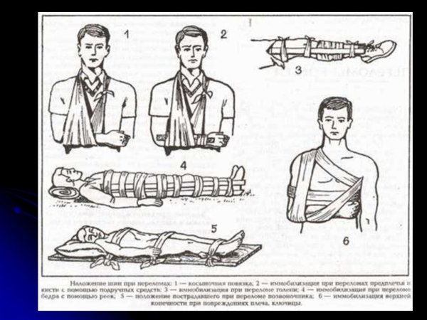 ПМП при переломах, травмах