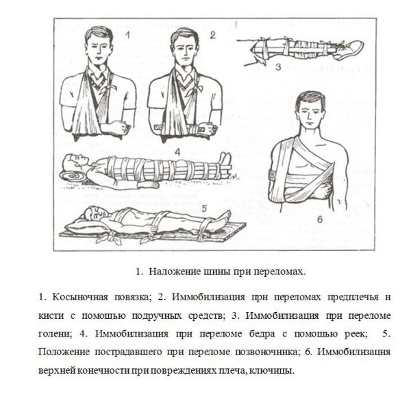 Накладывание шины при переломе