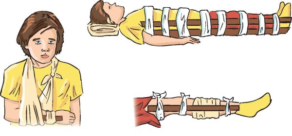 Иммобилизация конечности при переломе