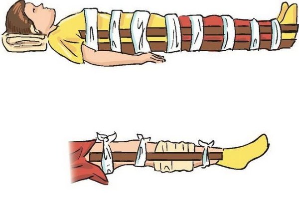 Наложение шины Крамера при переломе костей голени