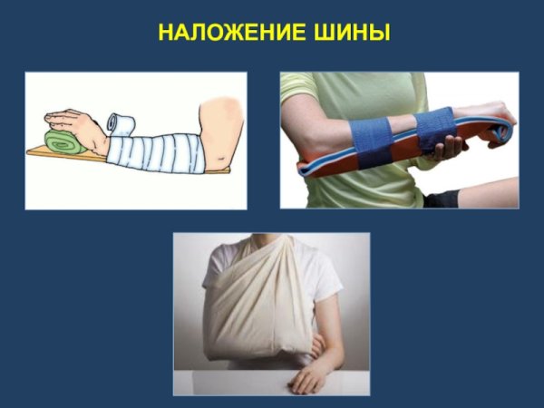Перелом костей предплечья иммобилизация
