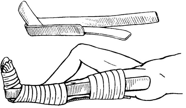 Транспортная иммобилизация шиной Крамера