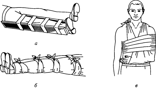 Шинирование конечностей при переломах