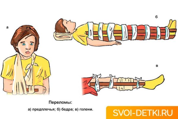 При переломе костей голени шина накладывается