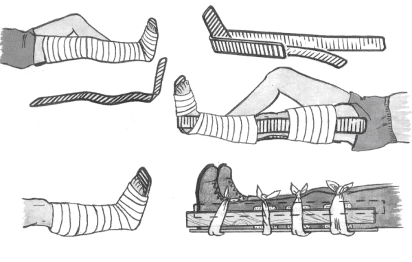 Шина Крамера при переломе голени