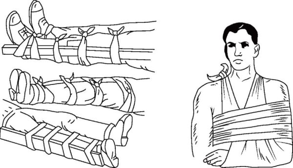 Переломы костей транспортная иммобилизация