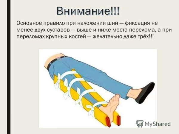 При переломах костей конечностей накладывается шина: