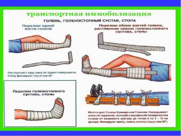 Техника иммобилизации при переломе костей голени вакуумными шинами