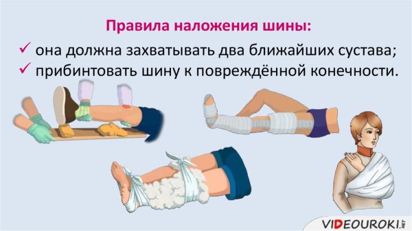 Правила наложения шины