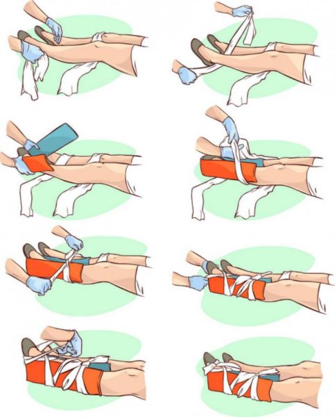 Наложение шин при переломах конечностей