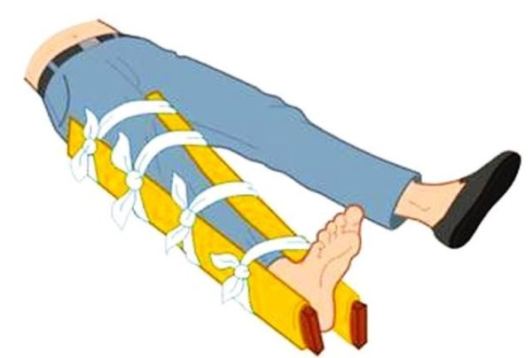 ПМП при переломе голени