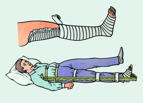 Транспортная иммобилизация при переломе голени