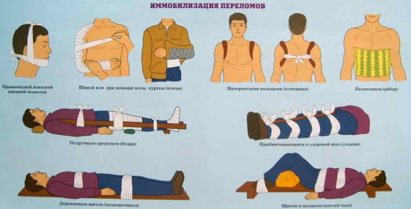 Первая помощь при переломах иммобилизация