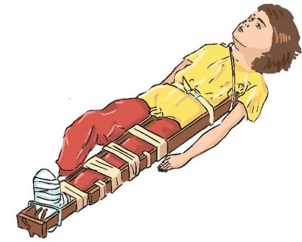 Перелом бедра шина Дитерихса