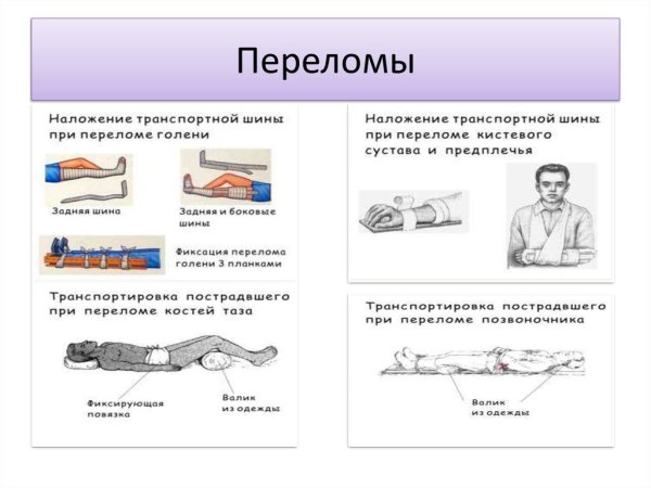 Схема накладывания шины при переломе