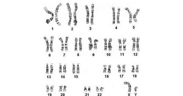 Кариотип 46 ХХ