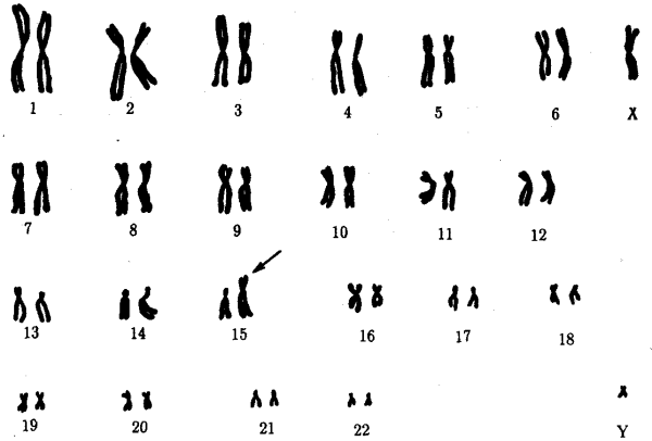 Синдром дисомии по у хромосоме кариотип