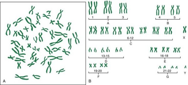 Идиограмма синдрома Патау
