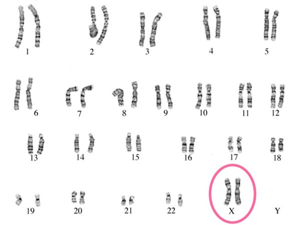 Кариотип больного с синдромом Клайнфельтера