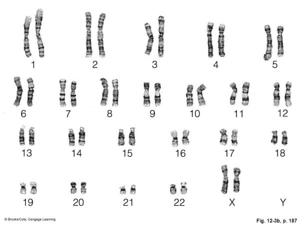 Кариограмма синдрома Эдвардса