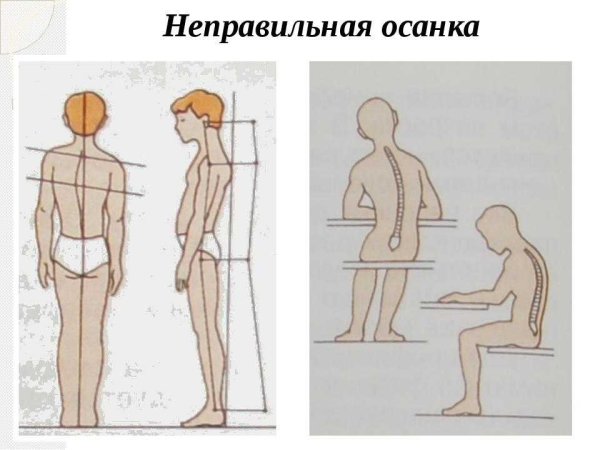 Правильная осанка