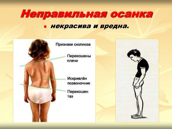Осанка у детей дошкольного возраста