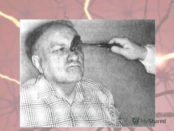 Корнеальный рефлекс (конъюнктивальный и роговичный)