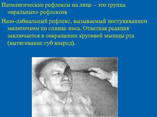 Ладонно-подбородочный рефлекс Маринеску-Радовичи