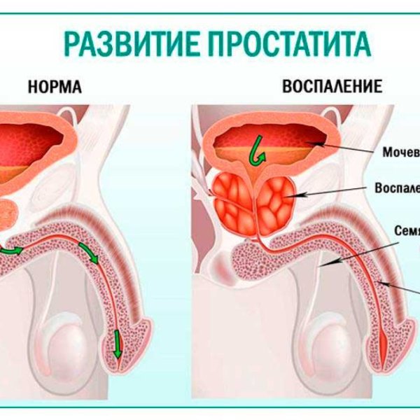 Предстательная железа у мужчин