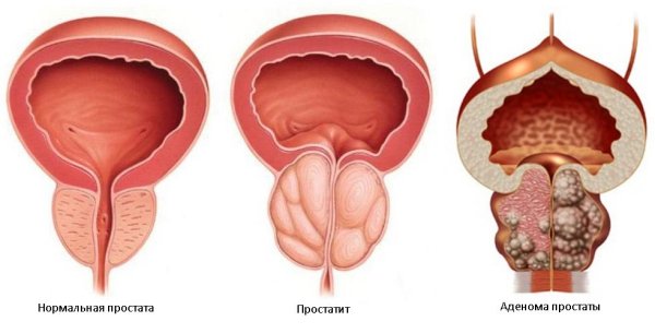 Предстательная железа, Prostata