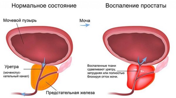 Анатомия аденомы предстательной железы