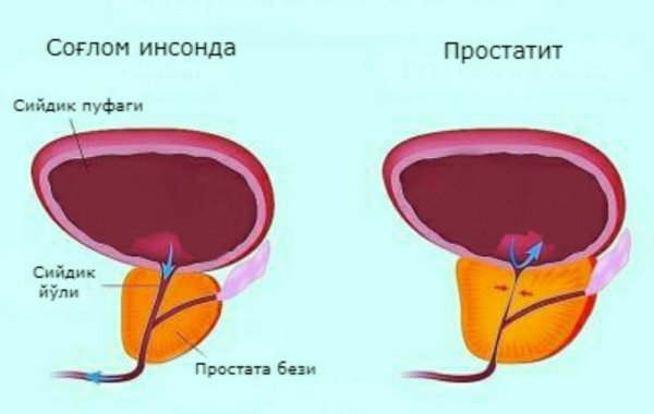 ДГПЖ предстательной железы что это такое