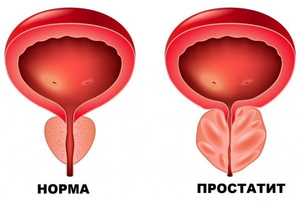 Кальцинаты предстательной железы