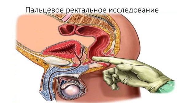Аденома простаты клиника