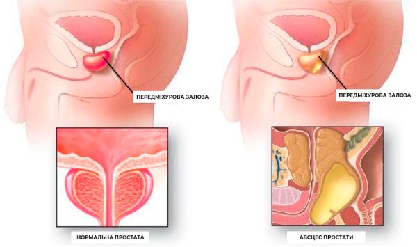 Предстательная железа, Prostata