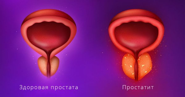 Раковые заболевания простаты
