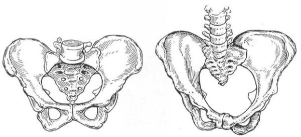 Рахитический таз Акушерство