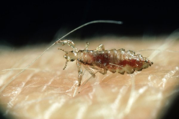 Вши в волосах под микроскопом