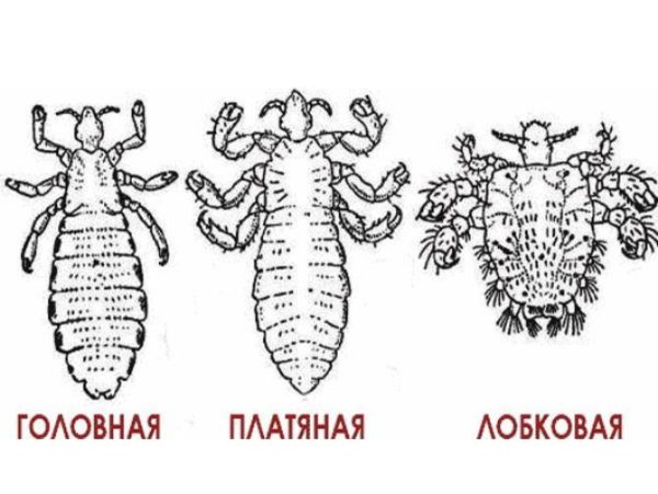 Педикулез волосистой части головы