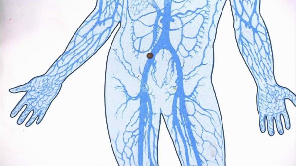 Тромбофлебит кубитальной вены